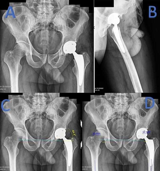 Unexpected transient femoral nerve palsy following epidural catheterization in total hip arthroplasty: A rare case report.