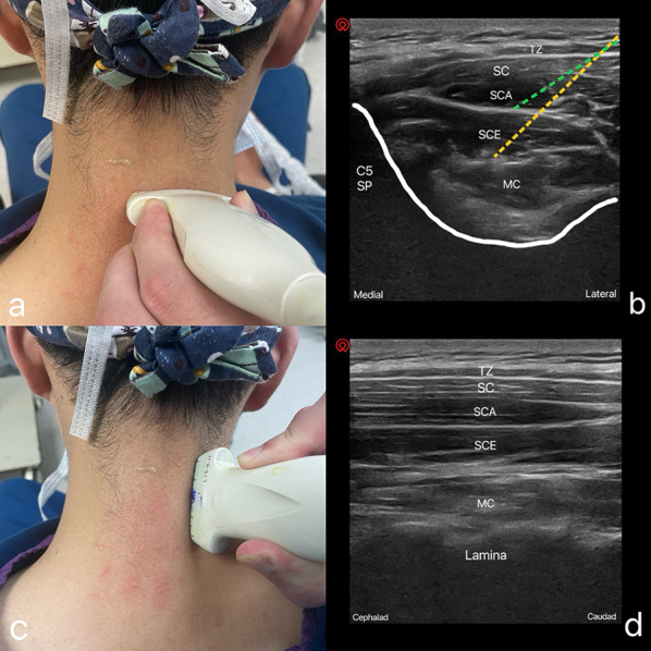 Understanding the Anatomy of Posterior Cervical Interfascial Space: Implications for Regional Blocks and Pain Management. A Narrative Review.