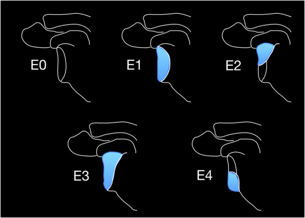 Management of Glenoid Bone Loss in Primary Reverse Total Shoulder Arthroplasty: A Critical Analysis Review.