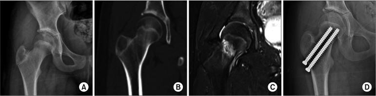 Adolescents with Low Body Mass Index Are More Vulnerable to Pediatric Nondisplaced Femoral Neck Fractures.