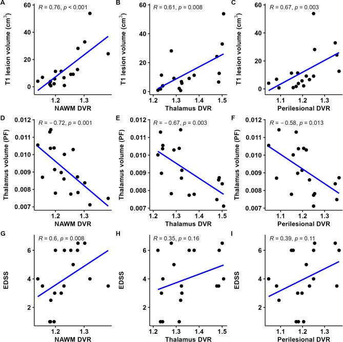 Longitudinal accumulation of glial activation measured by TSPO-PET predicts later brain atrophy in multiple sclerosis.