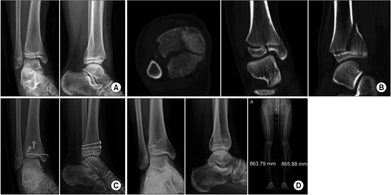 Comparison of Arthroscopic Reduction and Percutaneous Fixation Versus Open Reduction for Pediatric Intra-articular Epiphyseal Ankle Fractures.