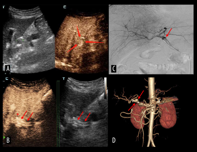 Intra-Arterial Contrast-Enhanced Ultrasound for Transcatheter Thrombolysis in Post-Transplant Hepatic Artery Thrombosis: A Preliminary Study.