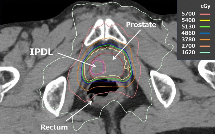 Narrative review of focal boost to intraprostatic dominant lesion in intensity-modulated radiation therapy for localized or locally advanced prostate cancer.