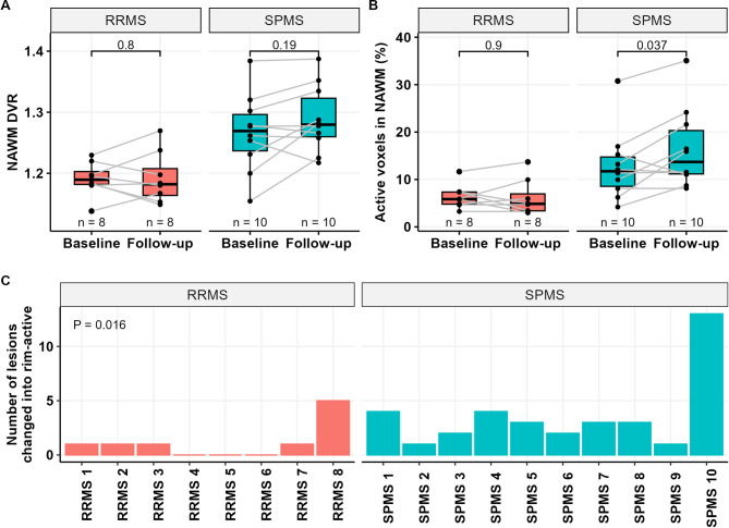 Longitudinal accumulation of glial activation measured by TSPO-PET predicts later brain atrophy in multiple sclerosis.