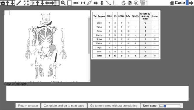 Preliminary validation of a web-based MRI scoring system for children with chronic nonbacterial osteomyelitis (ChRonic nonbacterial Osteomyelitis Magnetic Resonance Imaging Scoring: CROMRIS).