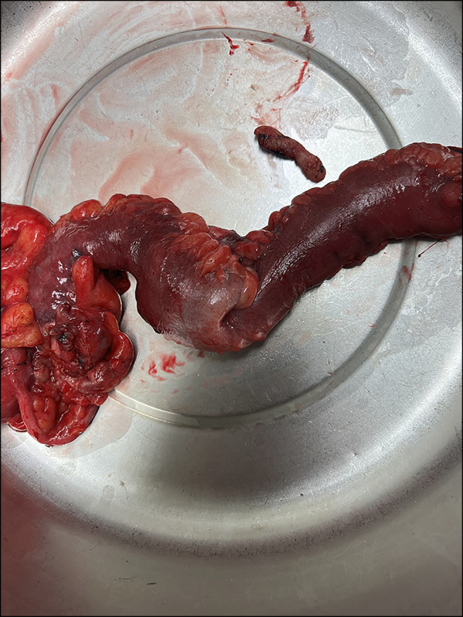Pyogenic Granuloma at the Ileocecal Junction: Unusual Culprit of Chronic Anemia and Intussusception.