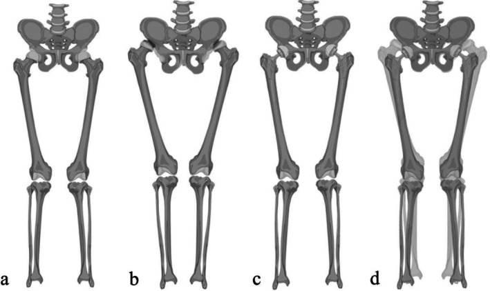 Decrease in Global Offset Leads to Complaints of Worsening of Valgus Knee Deformity After Total Hip Arthroplasty in Patients With Crowe Type IV Developmental Dysplasia of the Hip.