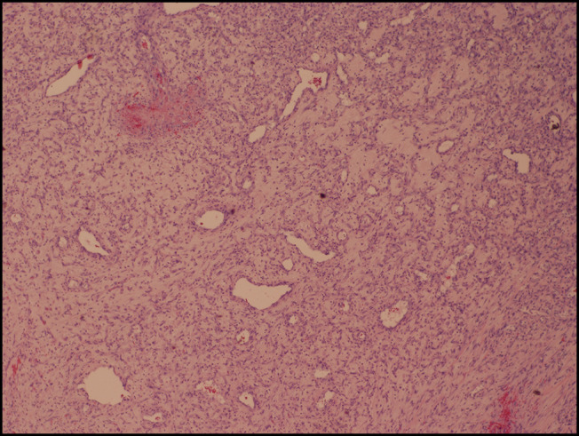 Pyogenic Granuloma at the Ileocecal Junction: Unusual Culprit of Chronic Anemia and Intussusception.