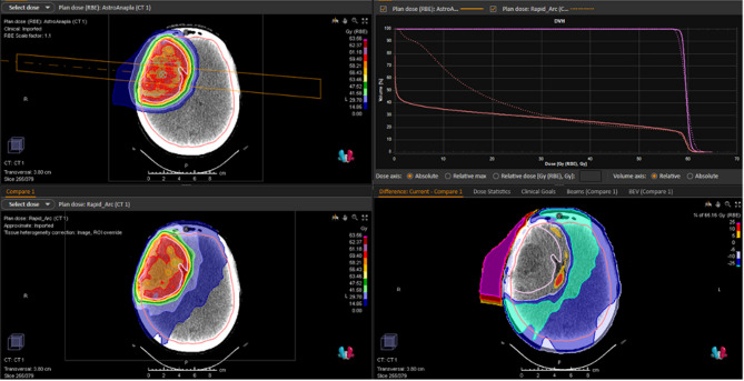 Proton therapy for adult type IDH-mutated glioma: Proglio-1, a multicenter retrospective study.