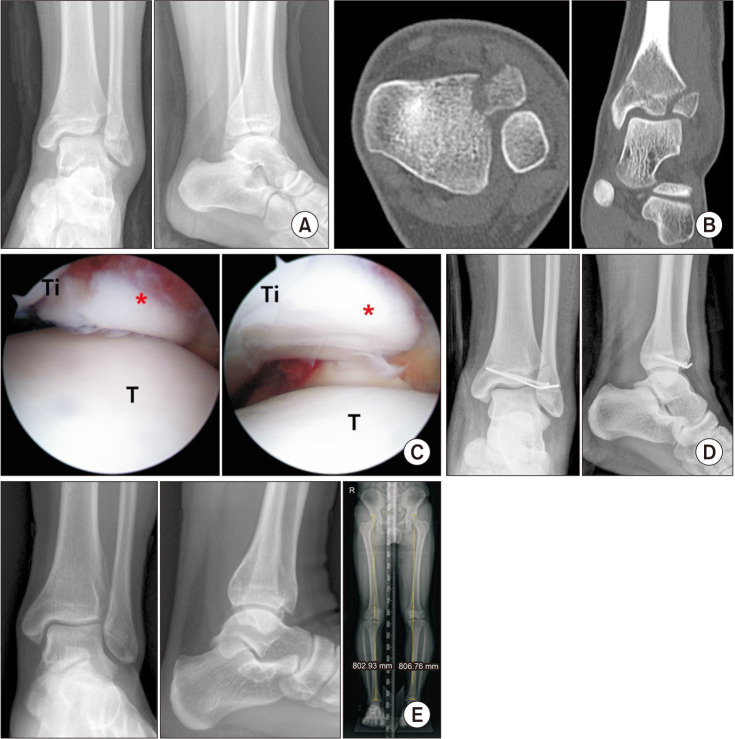Comparison of Arthroscopic Reduction and Percutaneous Fixation Versus Open Reduction for Pediatric Intra-articular Epiphyseal Ankle Fractures.