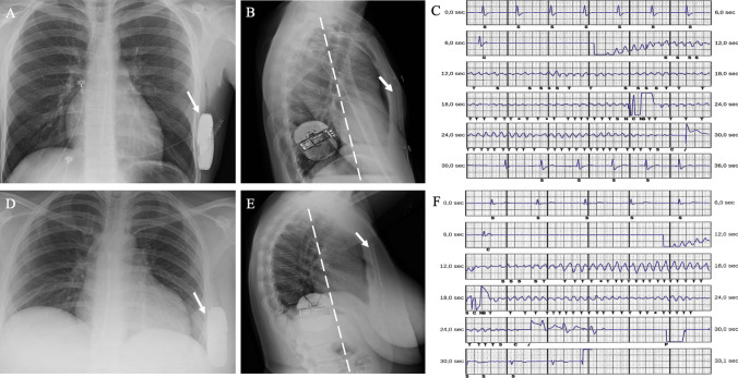 Intermuscular two-incision technique for implantation of the subcutaneous implantable cardioverter defibrillator: a 3-year follow-up.