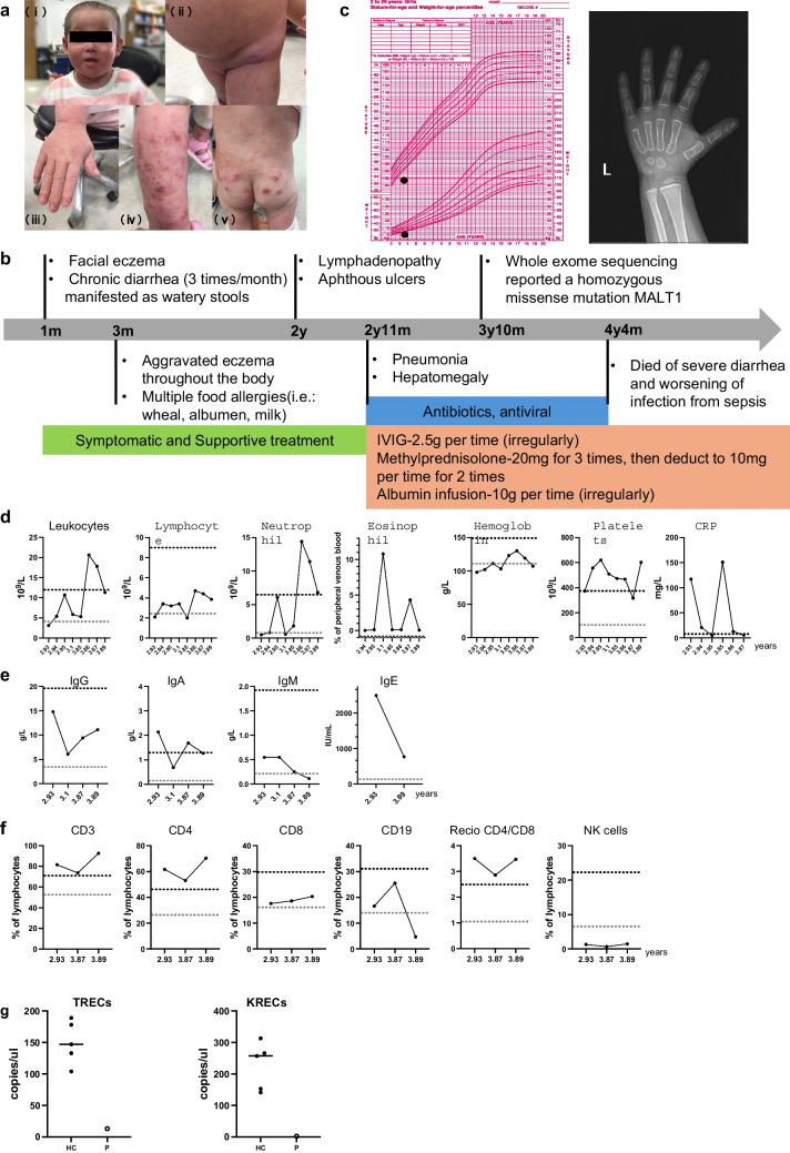 Loss of MALT1 Function in a Patient With Combined Immunodeficiency: a Novel Pathogenic Variant and Immunological Insights.