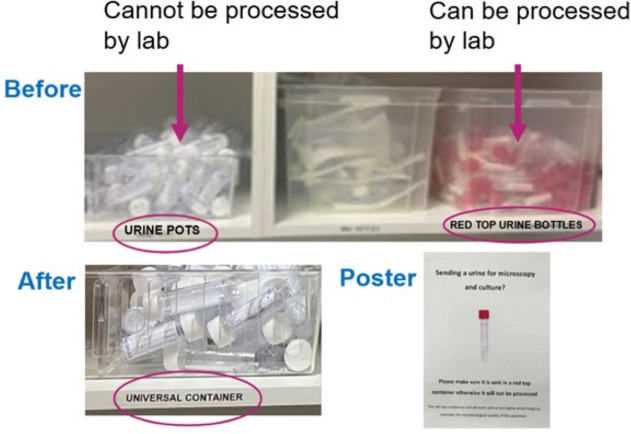 Quality improvement project to reduce length of stay for patients with urinary tract infections in an NHS hospital trust.