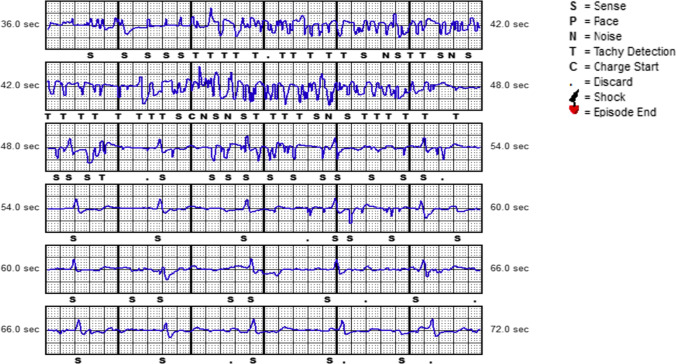 Intermuscular two-incision technique for implantation of the subcutaneous implantable cardioverter defibrillator: a 3-year follow-up.