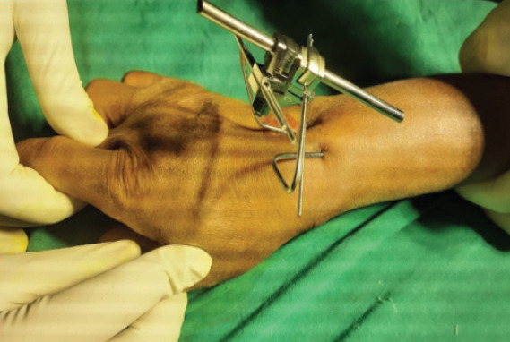 Modified Minimally Invasive Reduction and Osteosynthesis System Technique for Fixation of Distal Radius.