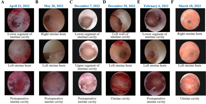 Live birth following multimodal therapy in a patient with asherman's syndrome, recurrent pregnancy loss, and polycystic ovarian syndrome: a case report and literature review.