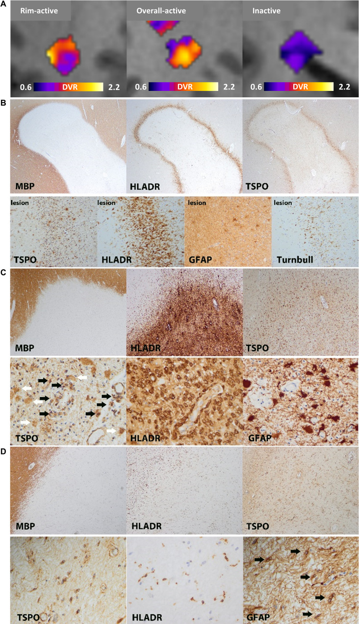 Longitudinal accumulation of glial activation measured by TSPO-PET predicts later brain atrophy in multiple sclerosis.