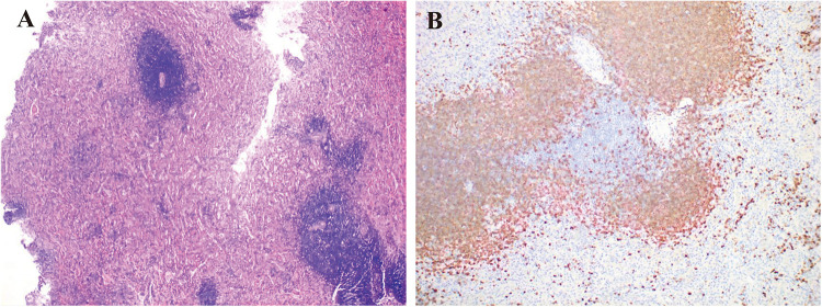 Splenectomy for Primary Sjögren's Syndrome Associated with Massive Splenomegaly: Two Case Reports.