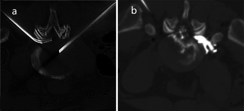 Efficacy of Combined High-Intensity Laser Therapy and Collagenase Chemonucleolysis in Lumbar Disc Herniation Management: a Prospective Randomized Controlled Trial.