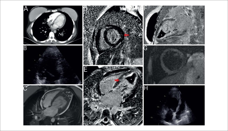 Surprising Cardiac Magnetic Resonance Imaging Findings: Rapidly Developing Intracardiac Thrombus with Endomyocardial Fibrosis.