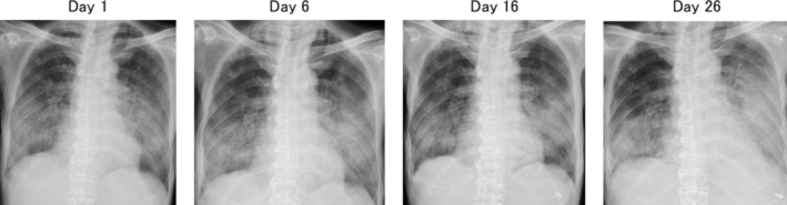 Pembrolizumab-Induced Severe Pneumonitis in a Patient With Lung Adenocarcinoma After Umbilical Cord Blood Transplantation: A Case Report.