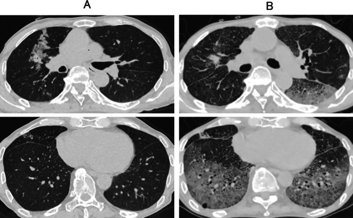 Pembrolizumab-Induced Severe Pneumonitis in a Patient With Lung Adenocarcinoma After Umbilical Cord Blood Transplantation: A Case Report.
