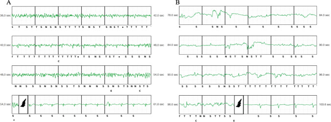 Intermuscular two-incision technique for implantation of the subcutaneous implantable cardioverter defibrillator: a 3-year follow-up.