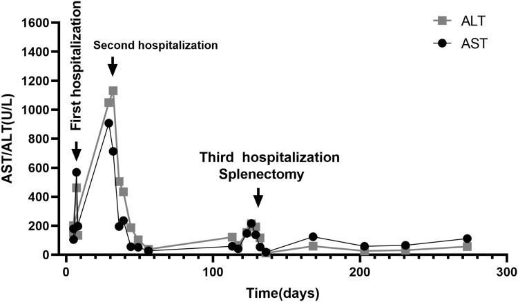 Splenectomy for Primary Sjögren's Syndrome Associated with Massive Splenomegaly: Two Case Reports.
