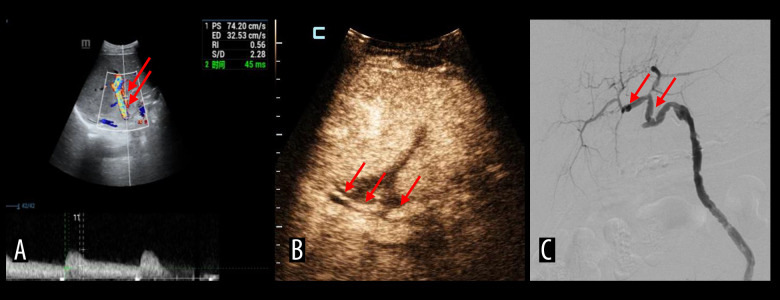 Intra-Arterial Contrast-Enhanced Ultrasound for Transcatheter Thrombolysis in Post-Transplant Hepatic Artery Thrombosis: A Preliminary Study.