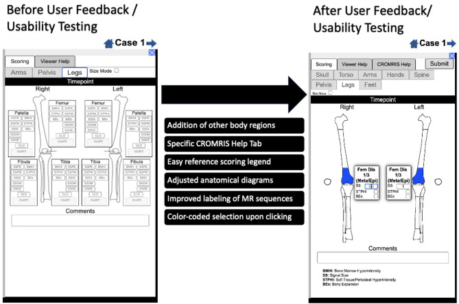 Preliminary validation of a web-based MRI scoring system for children with chronic nonbacterial osteomyelitis (ChRonic nonbacterial Osteomyelitis Magnetic Resonance Imaging Scoring: CROMRIS).