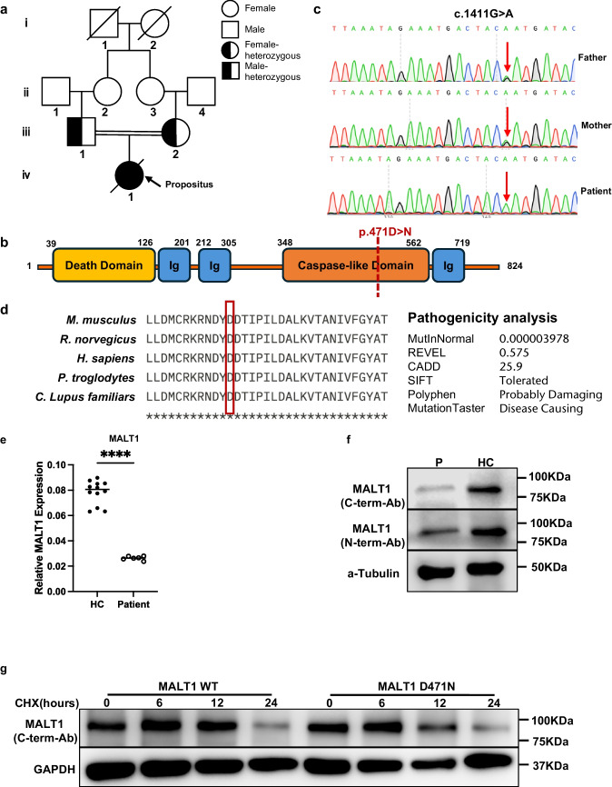 Loss of MALT1 Function in a Patient With Combined Immunodeficiency: a Novel Pathogenic Variant and Immunological Insights.