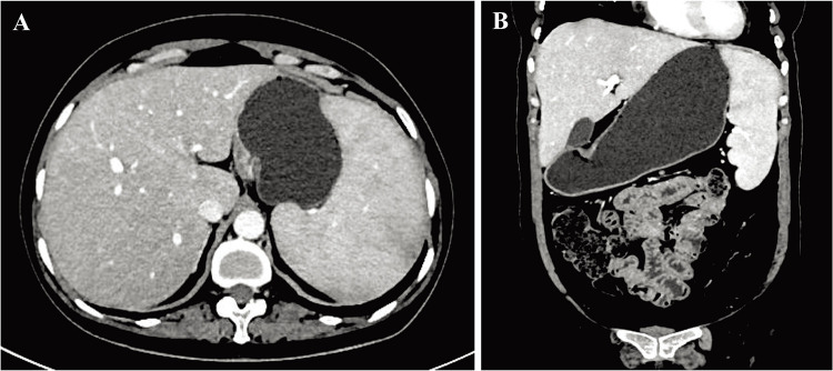 Splenectomy for Primary Sjögren's Syndrome Associated with Massive Splenomegaly: Two Case Reports.