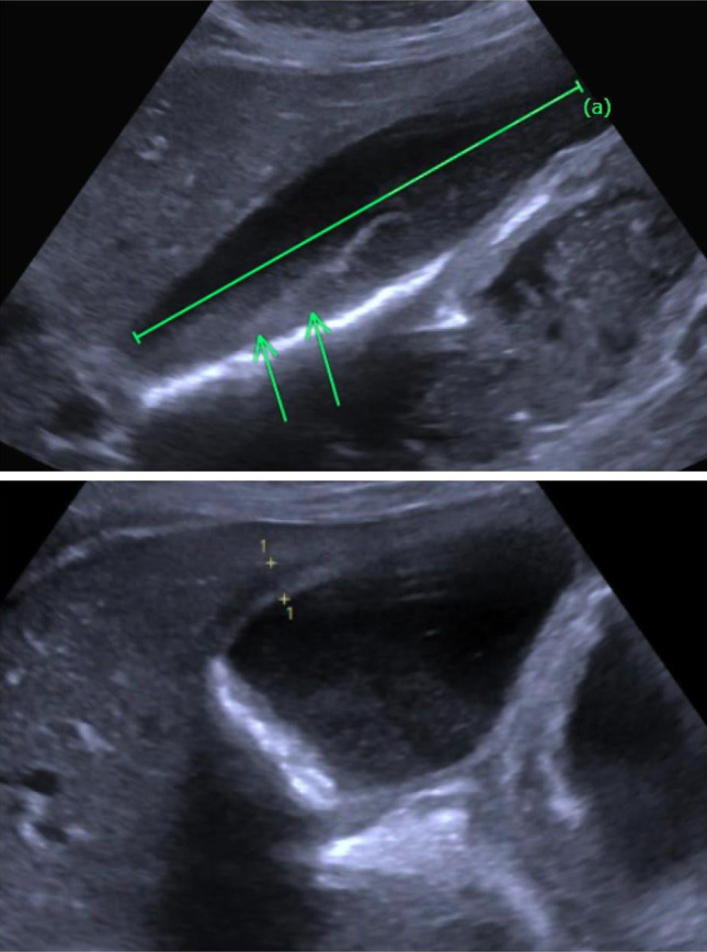 <i>Candida glabrata</i> Acalculous Cholecystitis in an Immunocompetent Host.