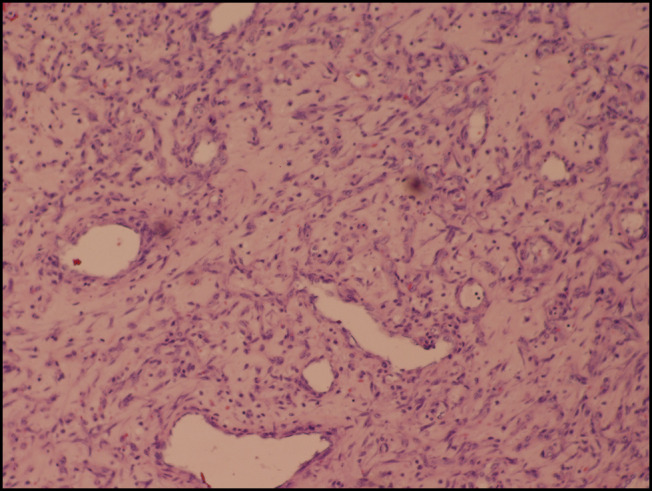 Pyogenic Granuloma at the Ileocecal Junction: Unusual Culprit of Chronic Anemia and Intussusception.