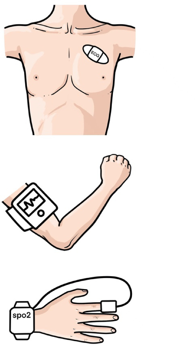Comparison of consistency between wireless and conventional wired monitoring systems in gastrointestinal endoscopy.