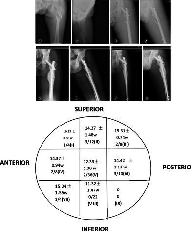 Exploring Appropriate Positioning of the Spiral Blade in Treatment of Subtrochanteric Fractures of the Femur Using Proximal Femoral Nail Antirotation.