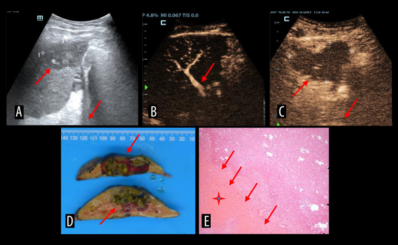 Intra-Arterial Contrast-Enhanced Ultrasound for Transcatheter Thrombolysis in Post-Transplant Hepatic Artery Thrombosis: A Preliminary Study.