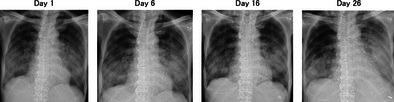 Pembrolizumab-Induced Severe Pneumonitis in a Patient With Lung Adenocarcinoma After Umbilical Cord Blood Transplantation: A Case Report.