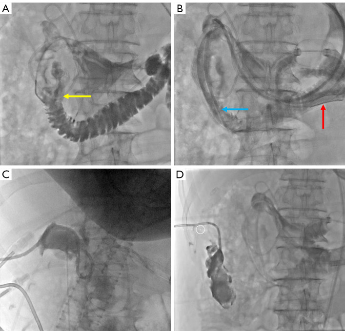 Interventional three-tube method for the management of duodenal perforation after endoscopic retrograde cholangiopancreatography for choledocholithiasis: a case series.