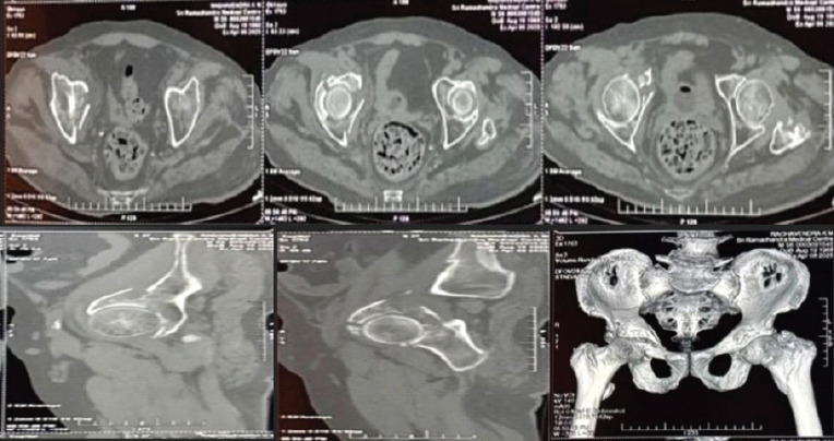 Management of Geriatric Acetabulum Fracture - A Case Report.