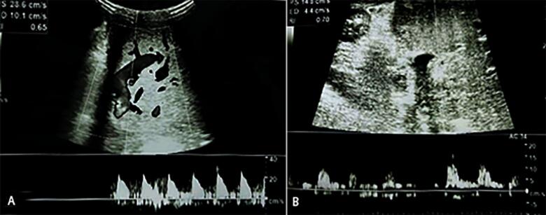 Impending arterial thrombosis in pediatric liver transplantation: Initial experience with alteplase - A case report.