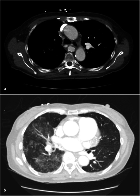 Proximal interruption of the pulmonary artery with systemic bronchial/intercostal aneurysm formation: a case report.
