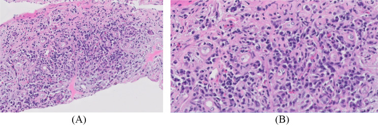 IgG4-related disease with interstitial nephritis in a patient with metastatic melanoma following immune checkpoint inhibitor treatment: a case report.