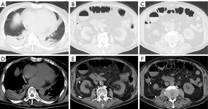 Interventional three-tube method for the management of duodenal perforation after endoscopic retrograde cholangiopancreatography for choledocholithiasis: a case series.