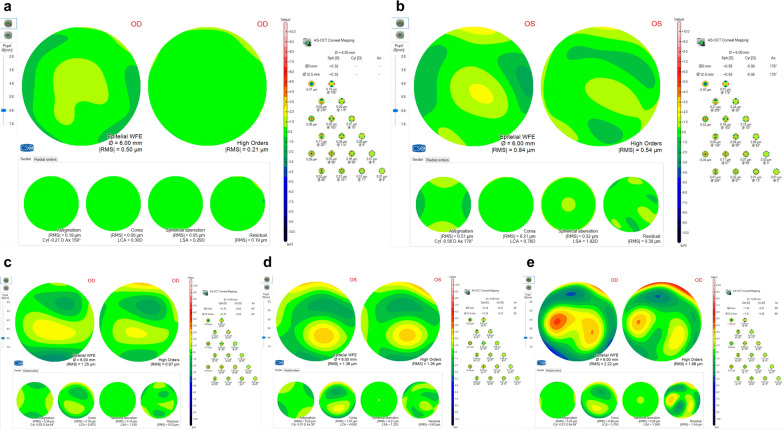 Corneal epithelial aberrations: a novel diagnostic tool for keratoconus and forme fruste keratoconus.
