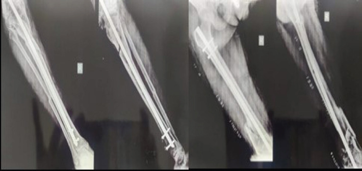 Knee Arthodesis , as a salvage procedure for Non-union of floating knee after ilizarov fixation-A case report.