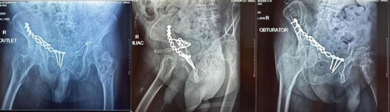 Management of Geriatric Acetabulum Fracture - A Case Report.