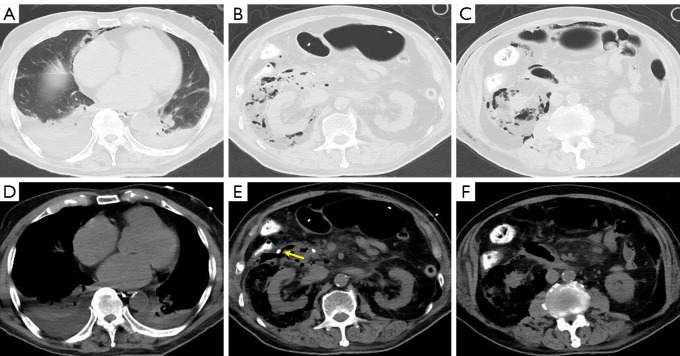 Interventional three-tube method for the management of duodenal perforation after endoscopic retrograde cholangiopancreatography for choledocholithiasis: a case series.