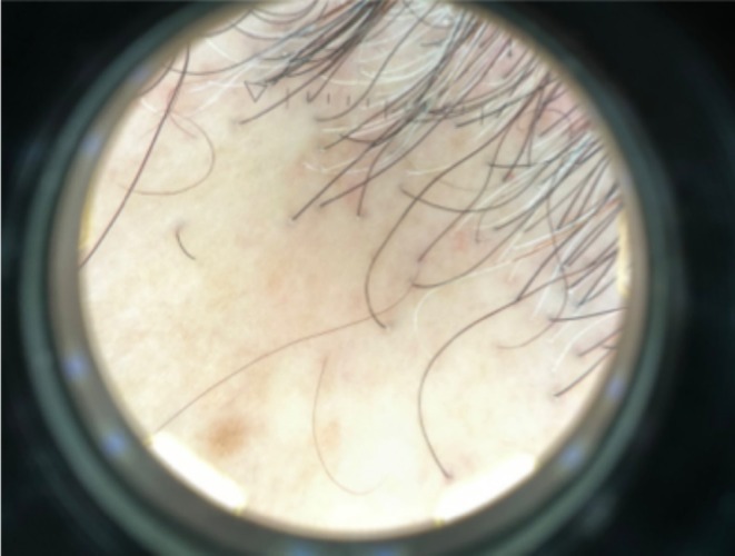 Familial Frontal Fibrosing Alopecia Occurs Early in Daughters With Affected Mothers: A Case Report and a Review of the Literature.